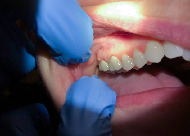 Best Emergency Dental Care for Broken or Chipped Teeth in Olga, FL